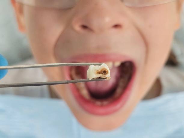 Best Emergency Tooth Extraction in Trenton, FL
